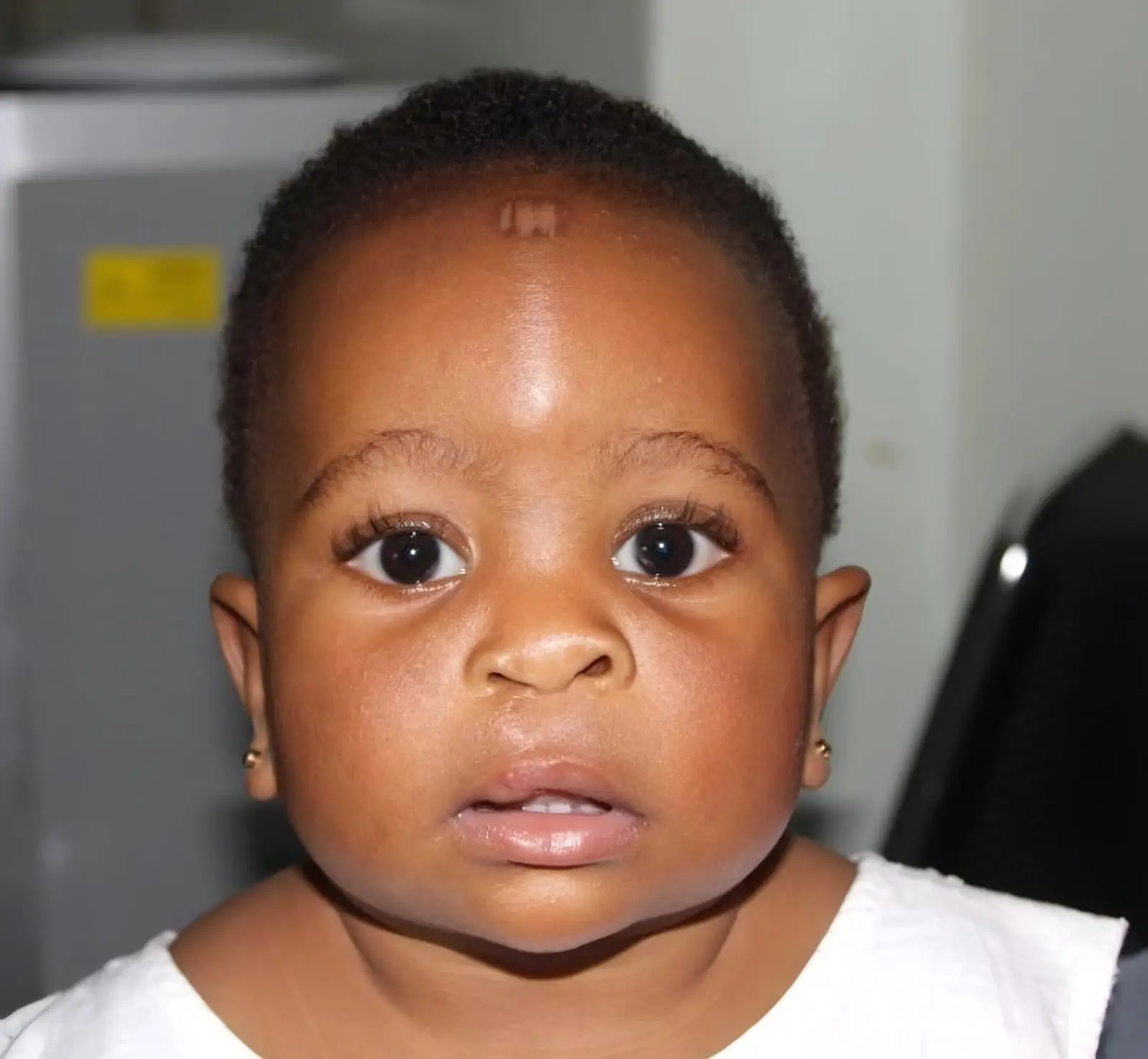 Limra as an older baby after her cleft lip repair, looking straight at the camera.