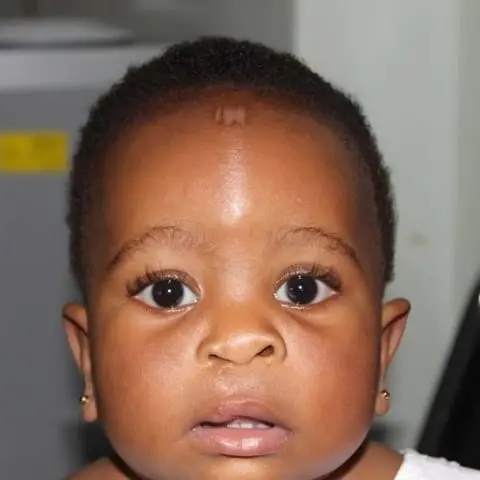 Limra, a toddler, after her cleft lip repair.
