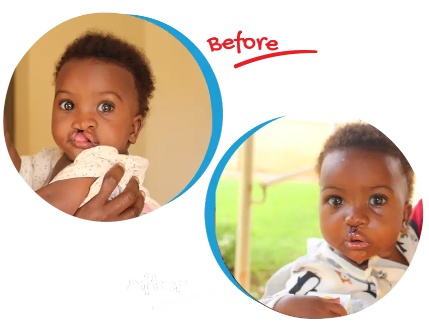 Before: a baby with a cleft lip. After: the same baby after lip repair surgery.